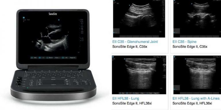 SonoSite Edge II Portable Ultrasound